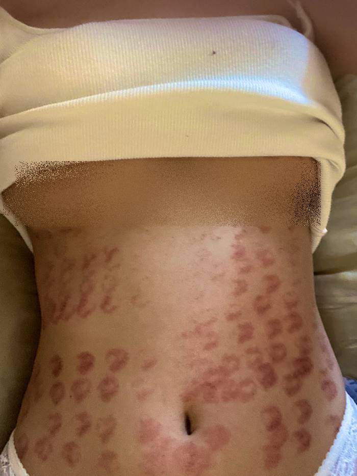 เลเซอร์กำจัดขน