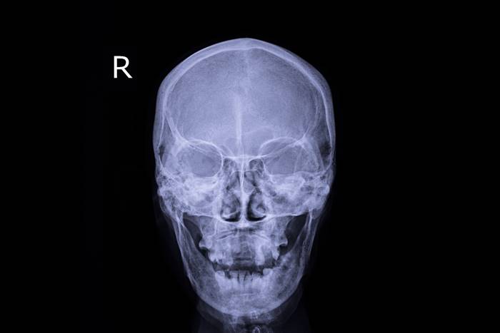 ตอกตะปูใส่ศีรษะ