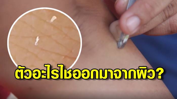 หนอนไชออกจากตัว