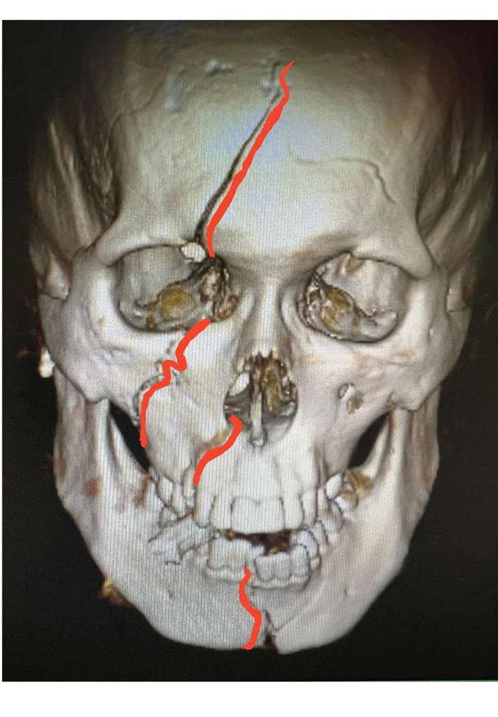 มอเตอร์ไซค์ล้ม