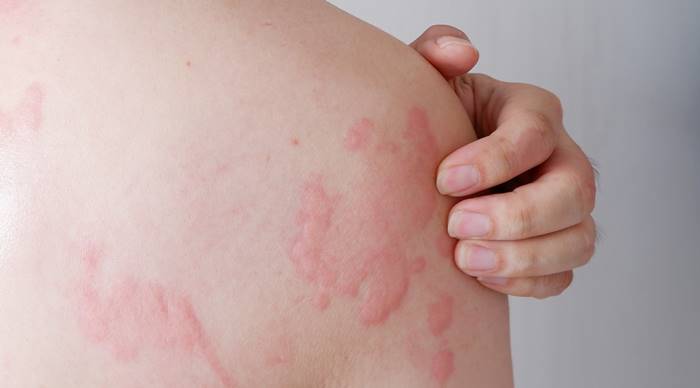 แพ้อสุจิ