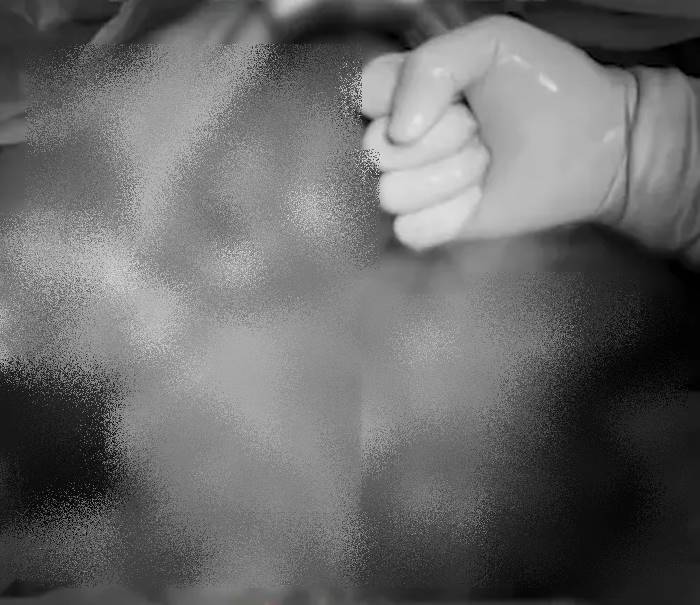 ท้องผูก