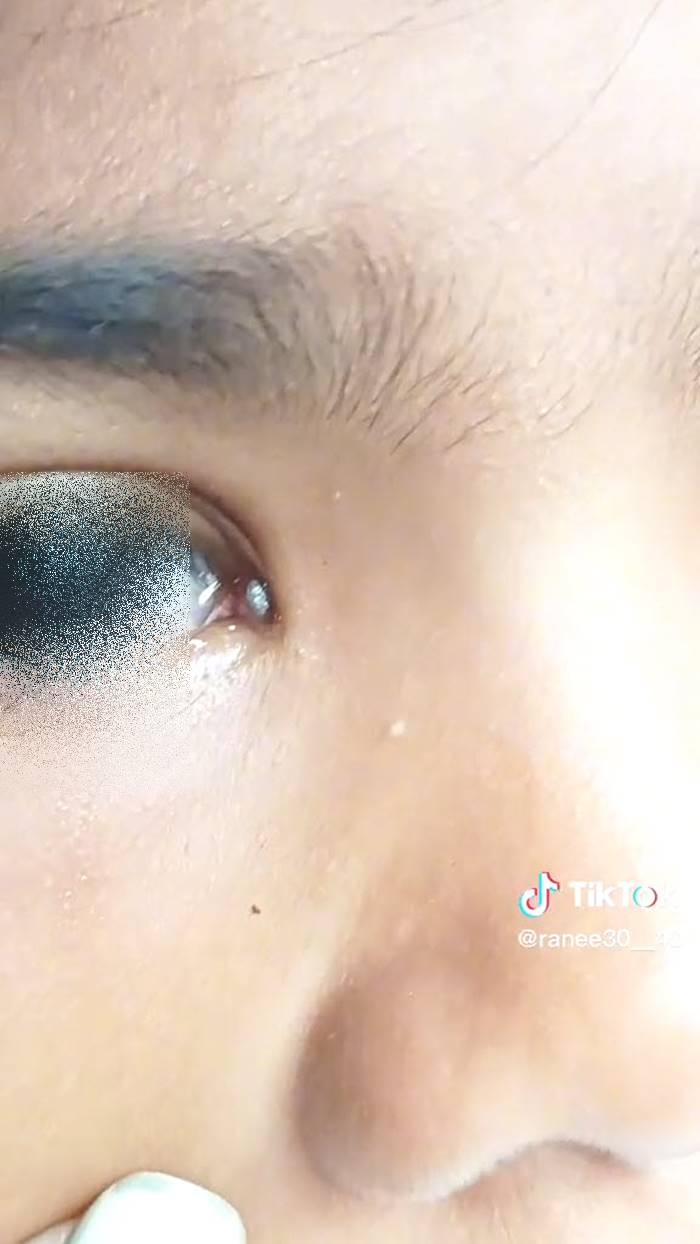 เห็บเกาะตา