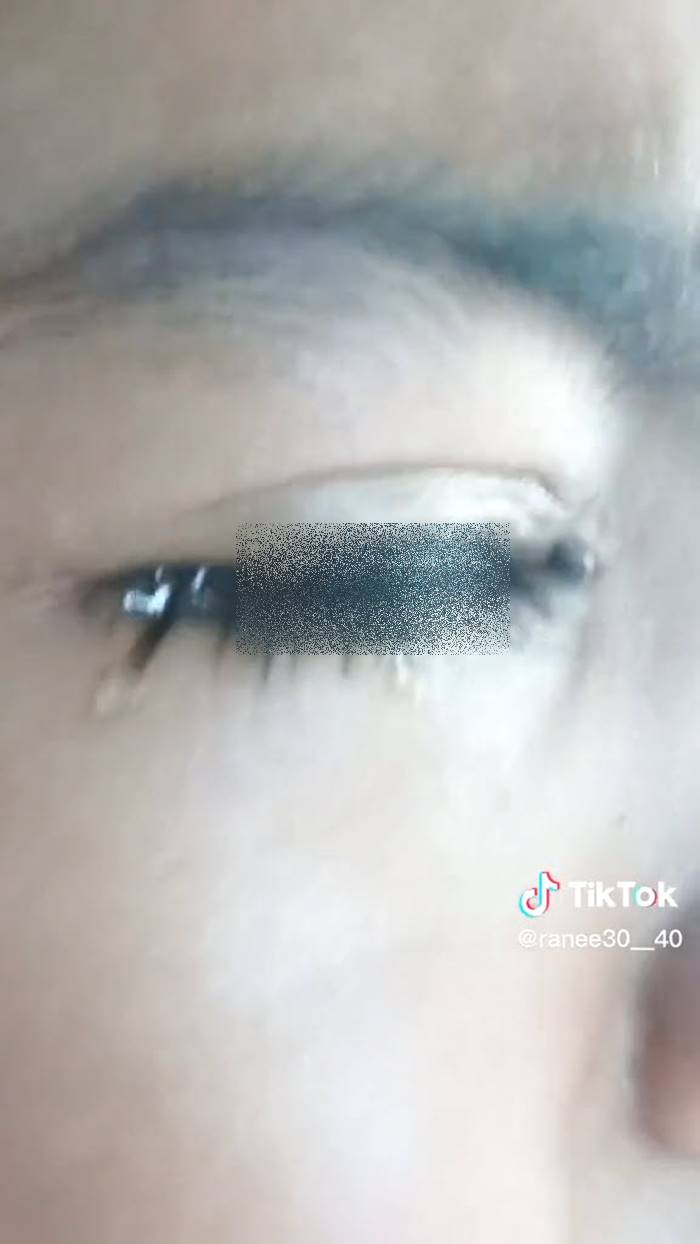 เห็บเกาะตา