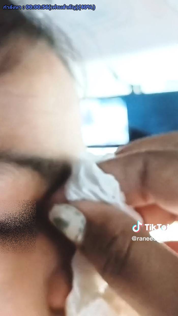 เห็บเกาะตา