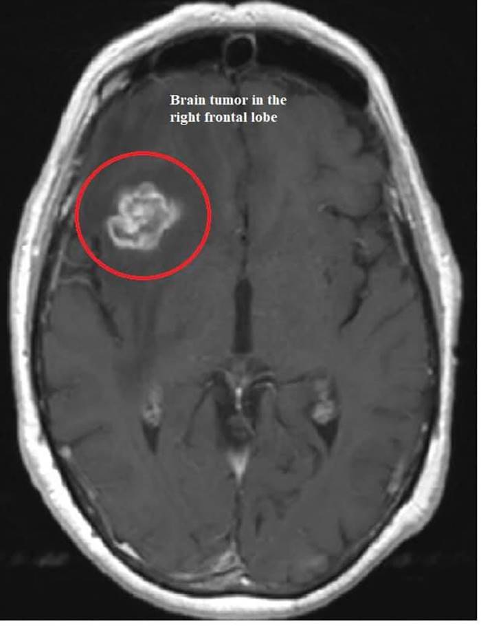  เนื้องอกในสมอง