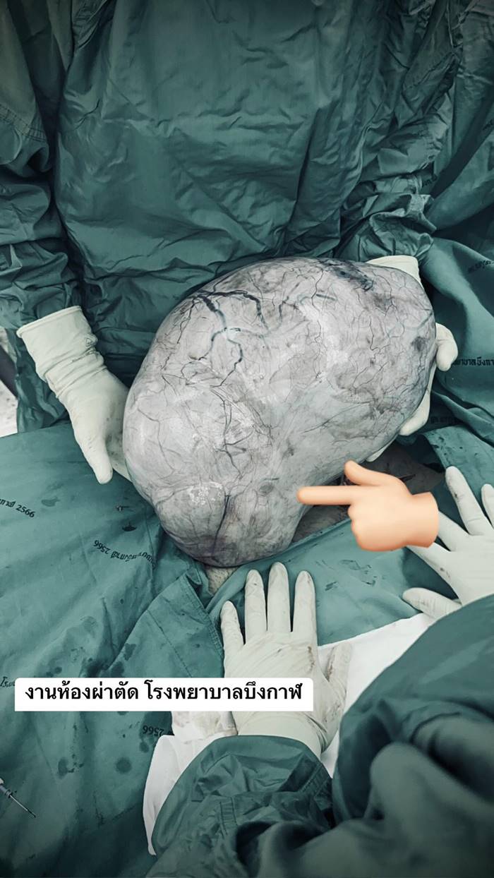 โรคถุงน้ำในรังไข่