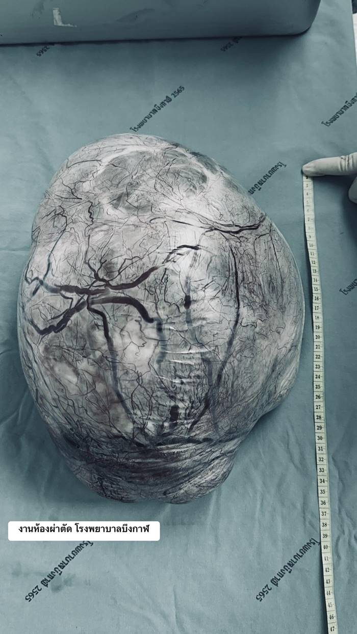 โรคถุงน้ำในรังไข่