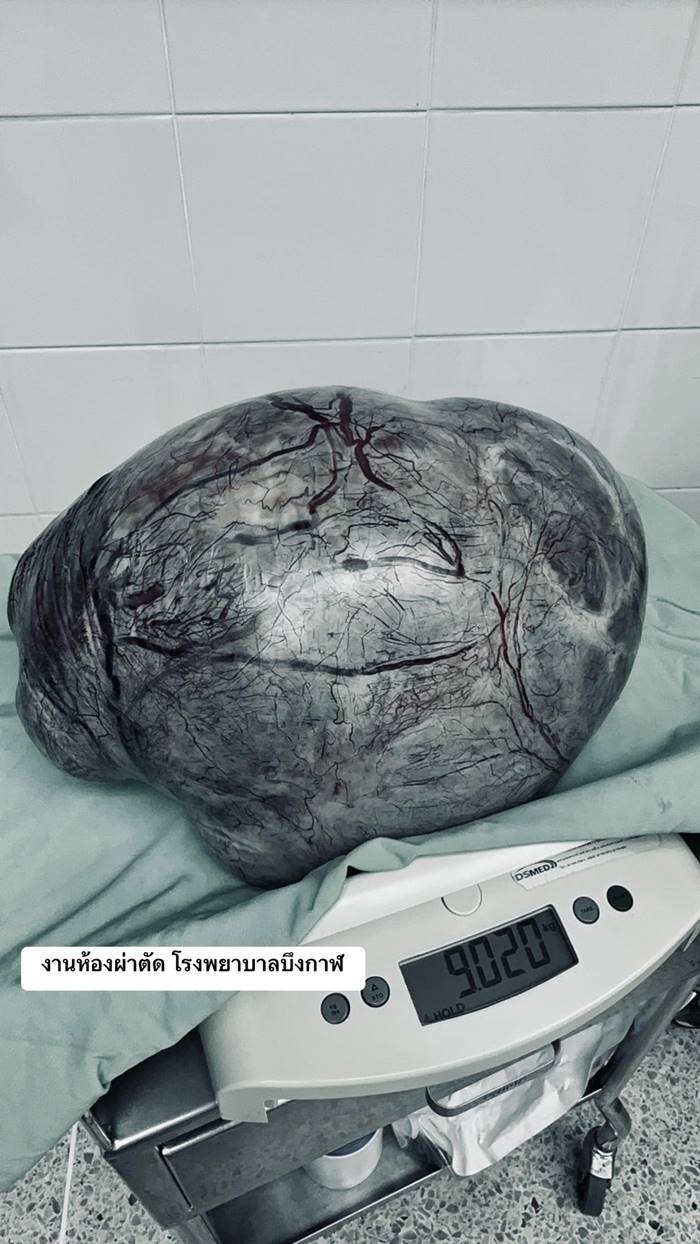 โรคถุงน้ำในรังไข่