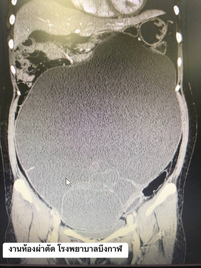 โรคถุงน้ำในรังไข่