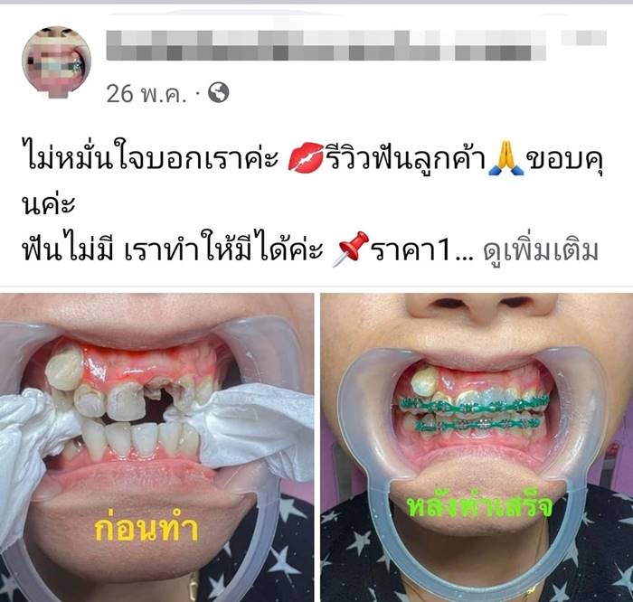 จัดฟันแฟชั่น