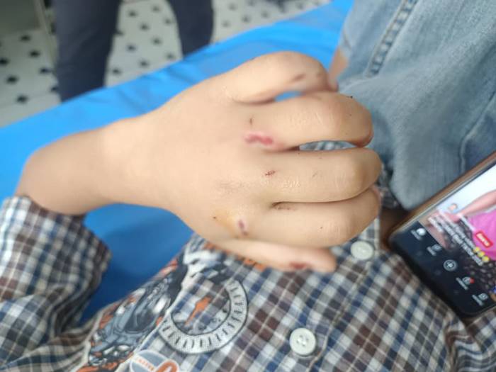 หมากัดเด็ก