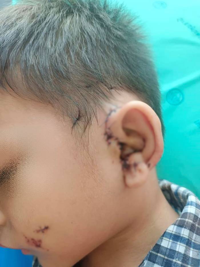 หมากัดเด็ก