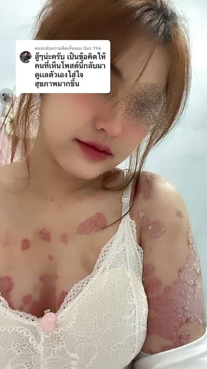 ภูมิคุ้มกันบกพร่อง
