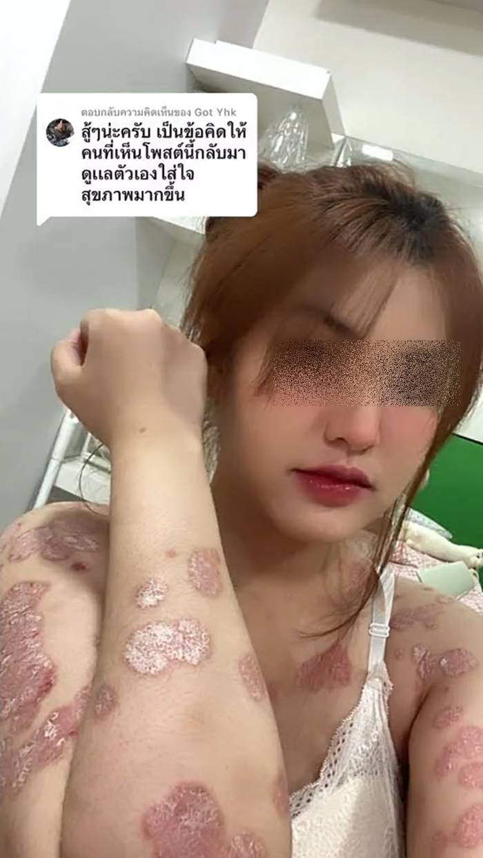 ภูมิคุ้มกันบกพร่อง