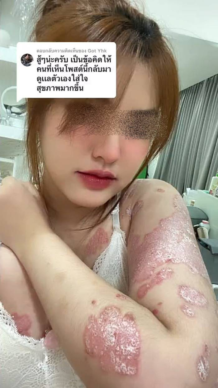 ภูมิคุ้มกันบกพร่อง