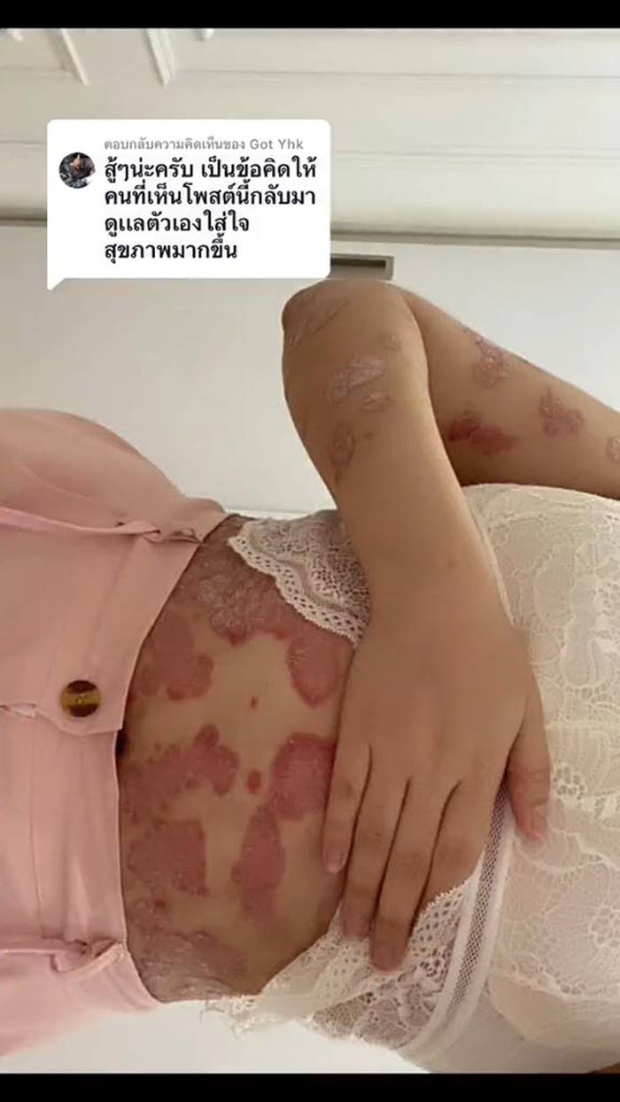 ภูมิคุ้มกันบกพร่อง