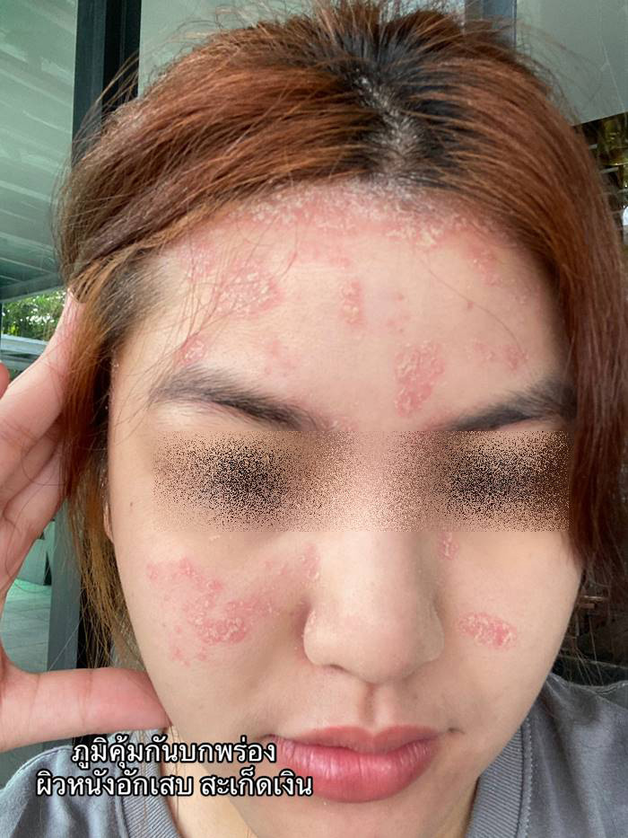 ภูมิคุ้มกันบกพร่อง