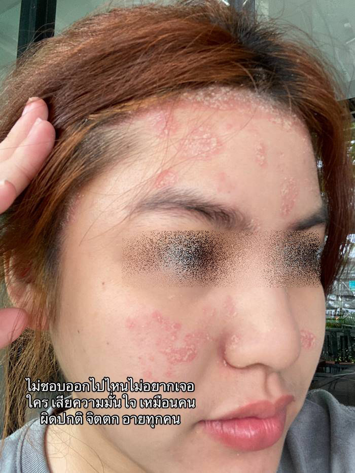ภูมิคุ้มกันบกพร่อง