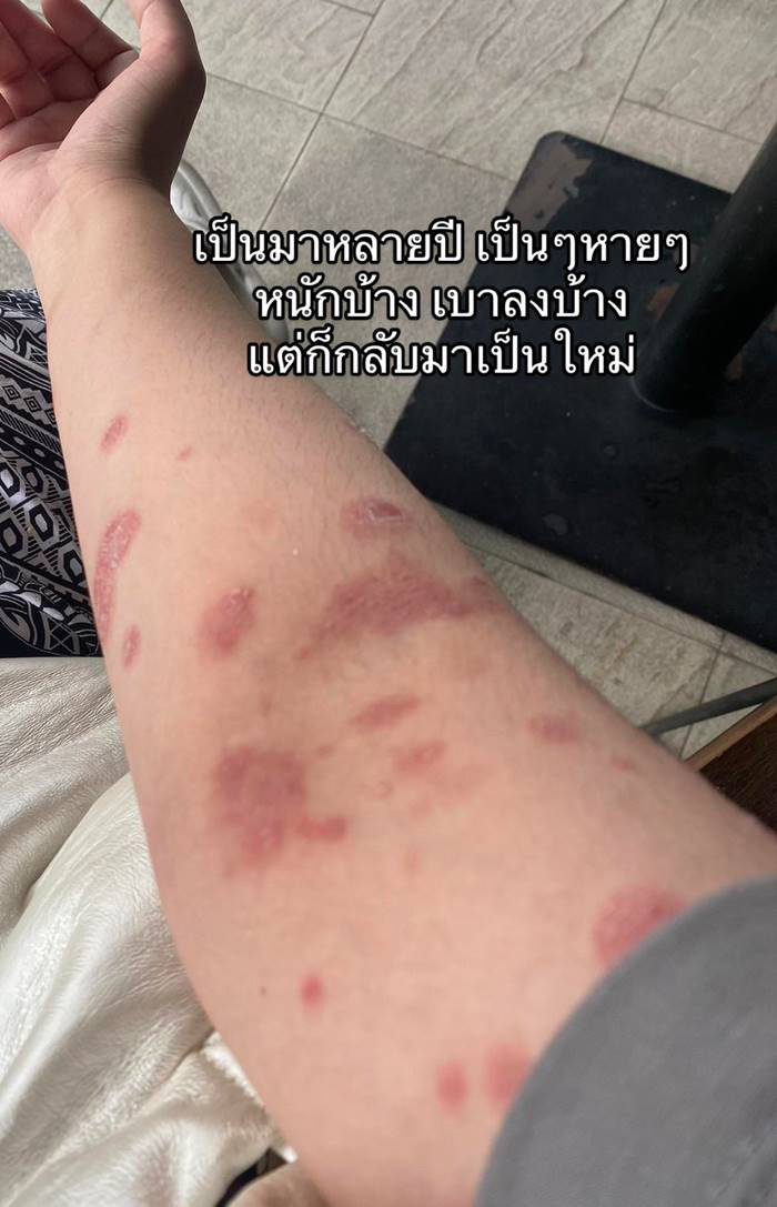 ภูมิคุ้มกันบกพร่อง