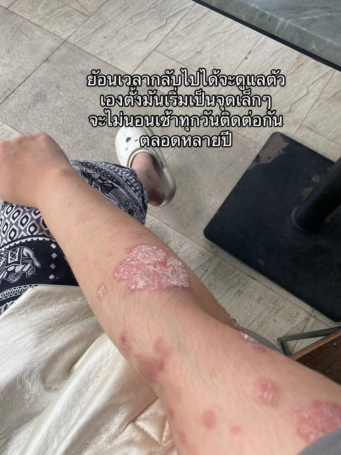 ภูมิคุ้มกันบกพร่อง