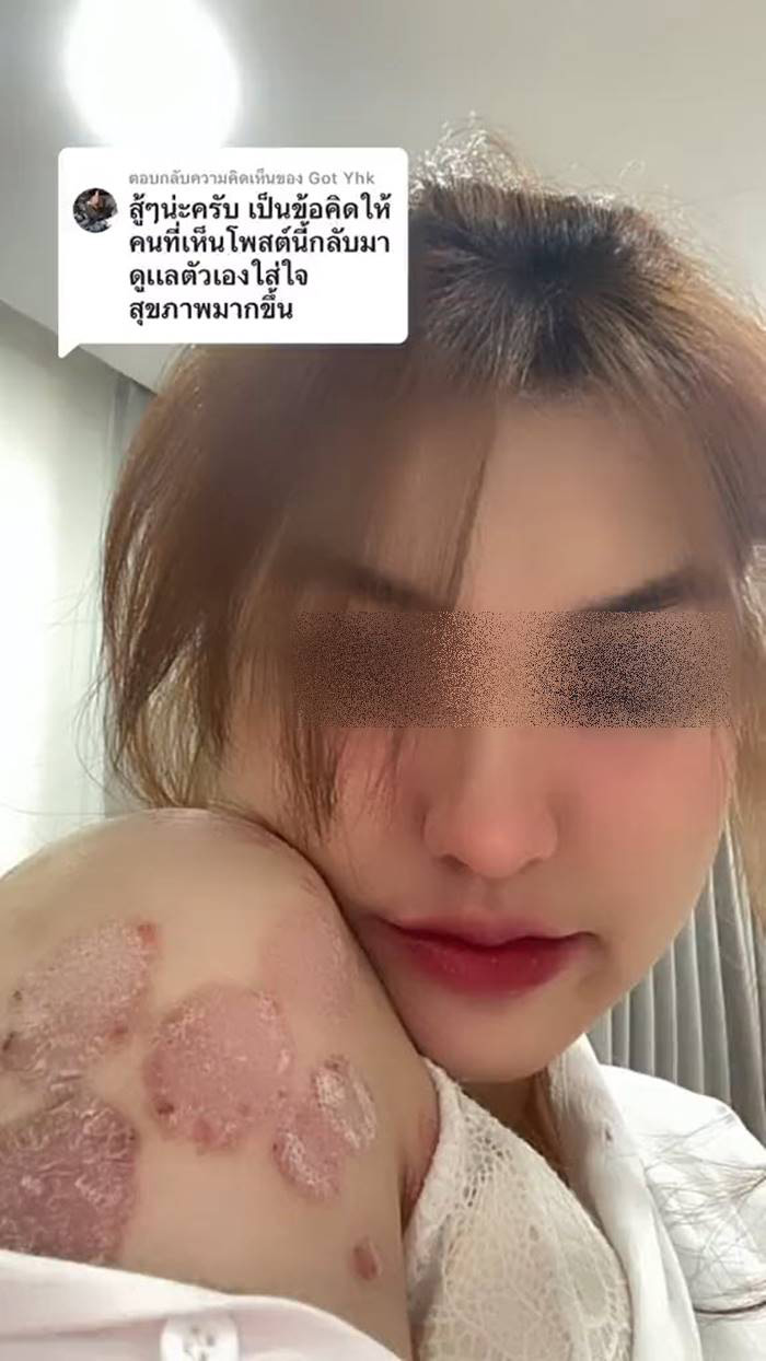 ภูมิคุ้มกันบกพร่อง