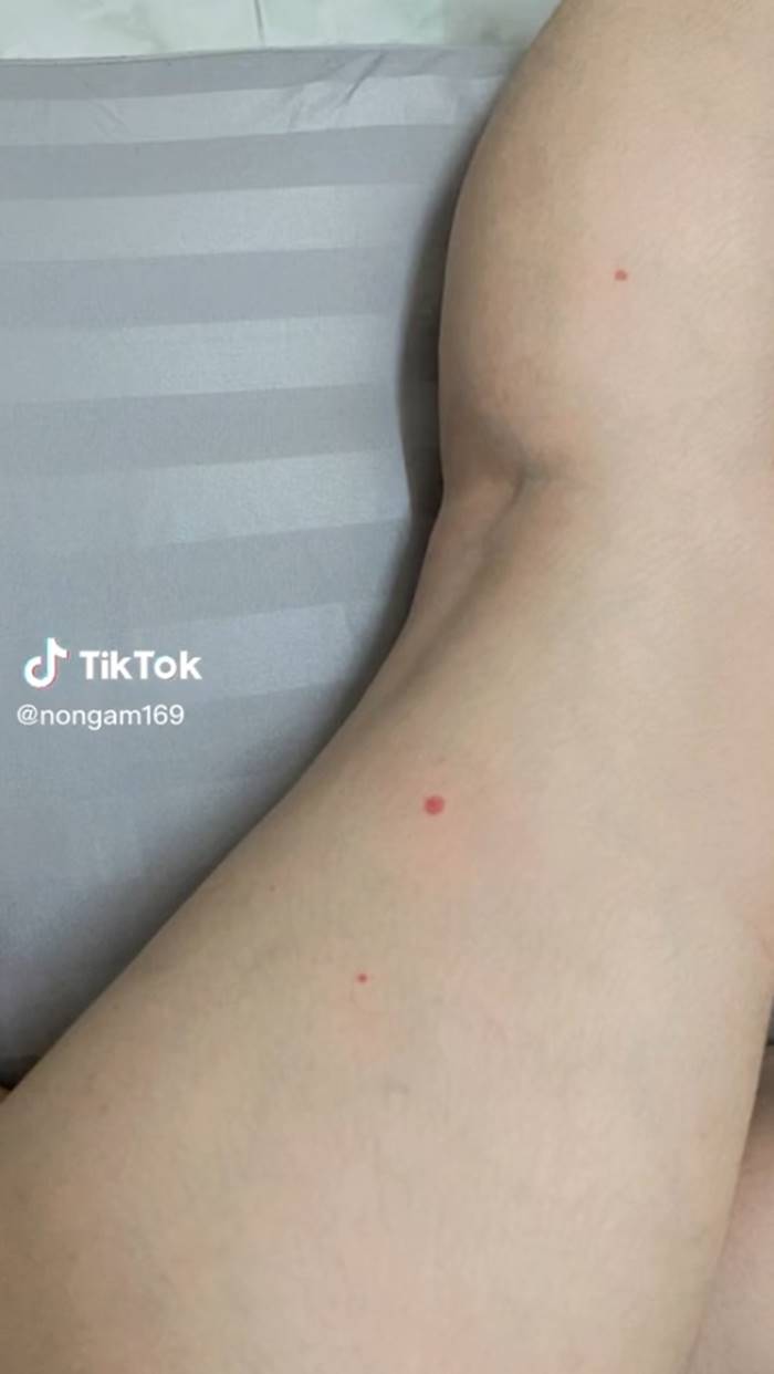 โรคเส้นเลือดอักเสบ