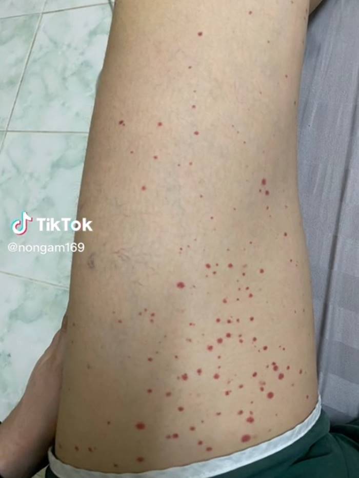 โรคเส้นเลือดอักเสบ