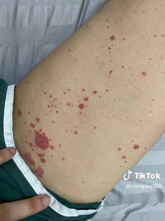 โรคเส้นเลือดอักเสบ