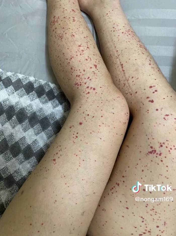 โรคเส้นเลือดอักเสบ