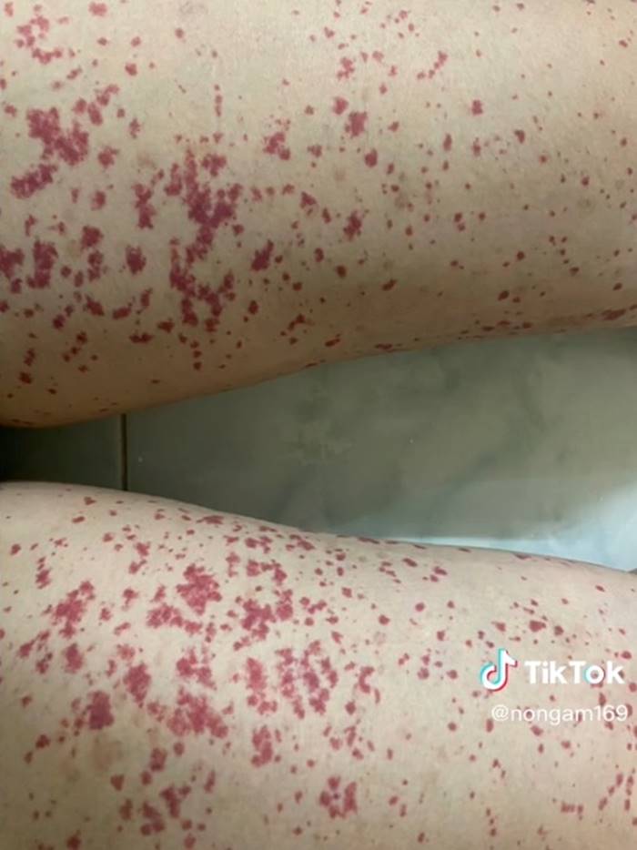 โรคเส้นเลือดอักเสบ