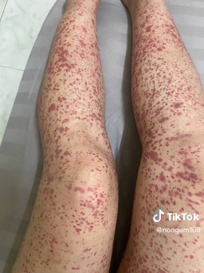 โรคเส้นเลือดอักเสบ