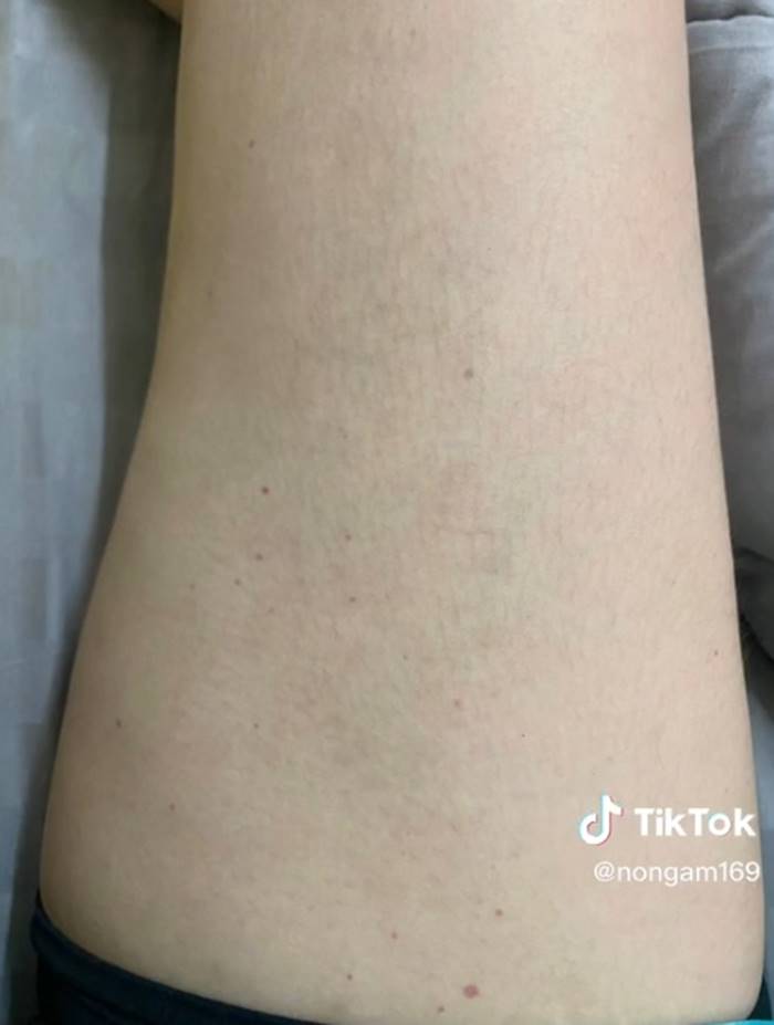 โรคเส้นเลือดอักเสบ