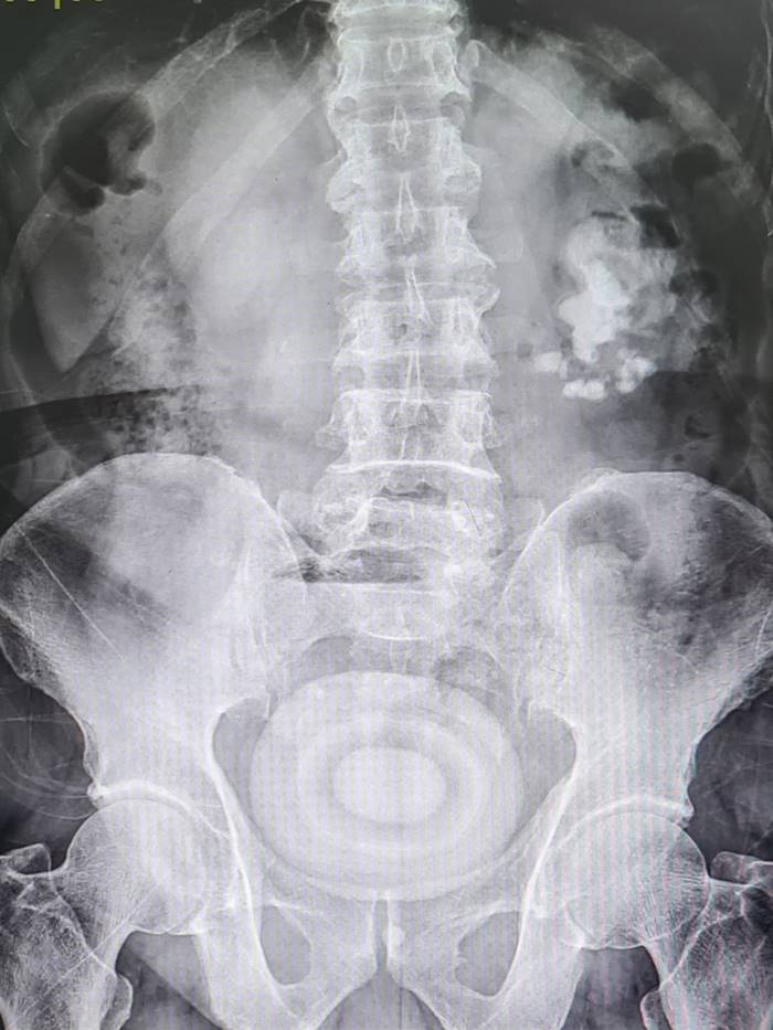 นิ่วในกระเพาะปัสสาวะ