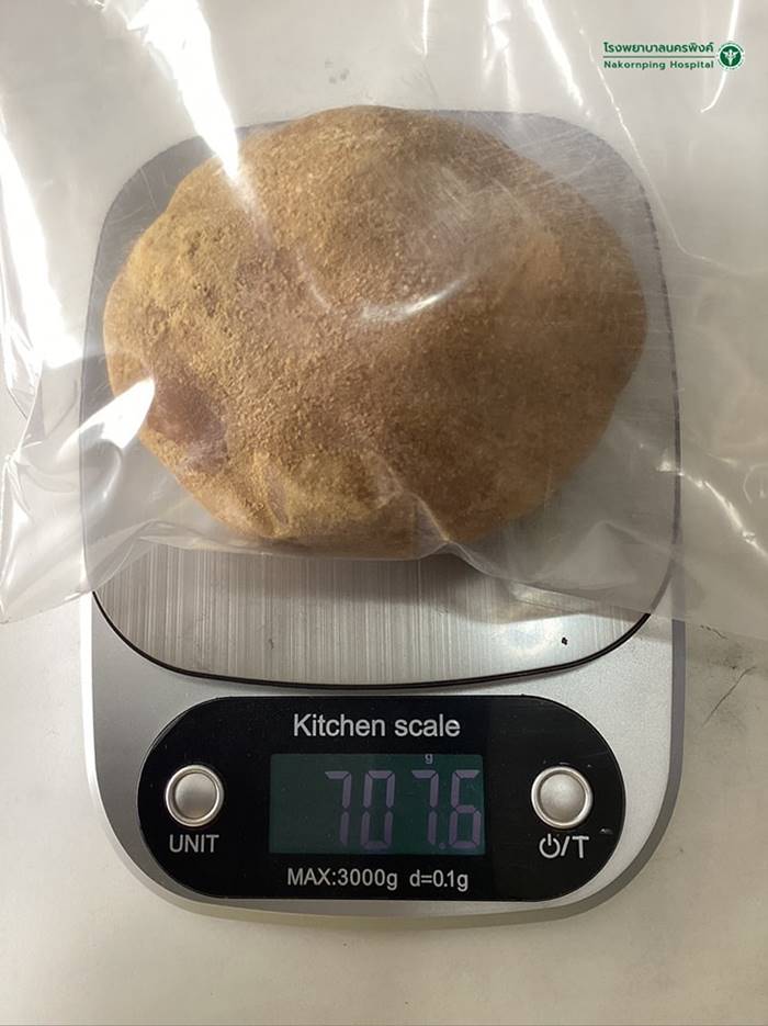 นิ่วในกระเพาะปัสสาวะ