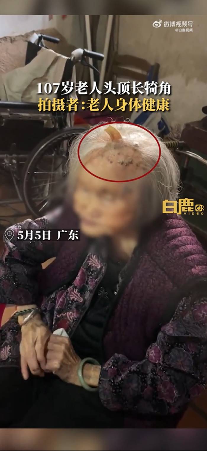 เนื้องอก