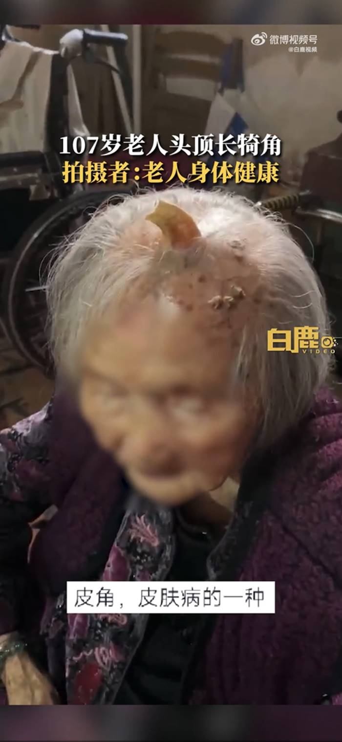 เนื้องอก