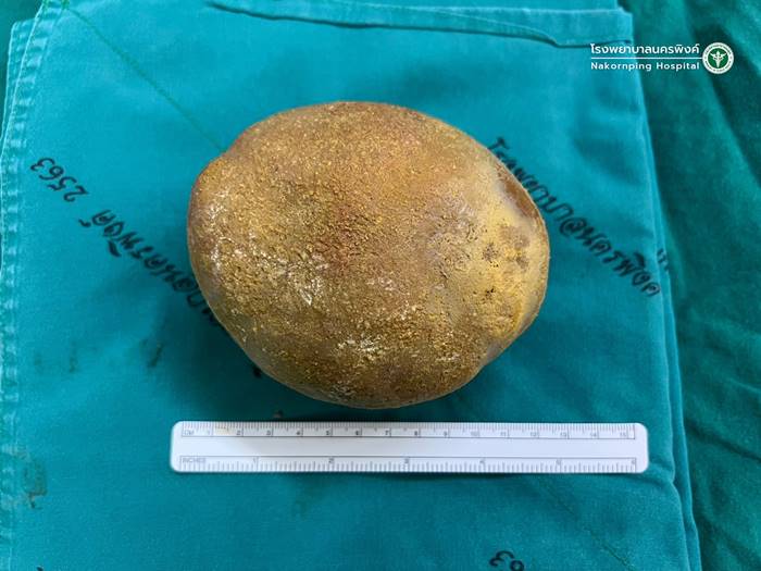 นิ่วในกระเพาะปัสสาวะ