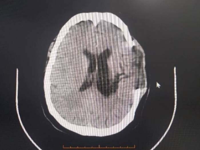 เส้นเลือดในสมองแตก