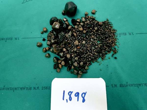 นิ่วในถุงน้ำดี