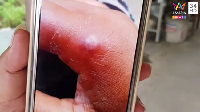 แมงมุมกัด