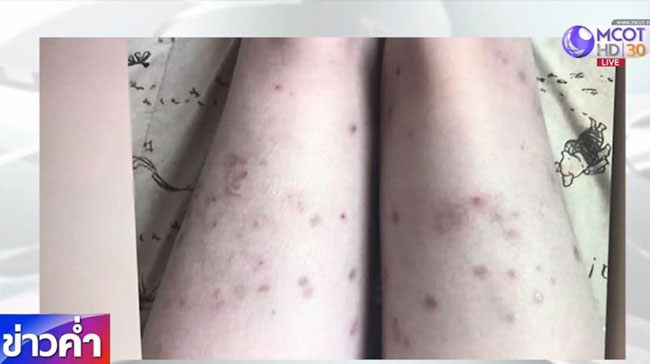 โรคจากหมัดแมว