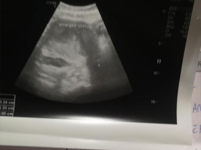 ประจำเดือนมาผิดปกติ