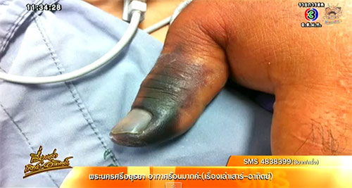 กู้ภัยพลาดโดนงูเห่าปลวกฉก อาการโคม่า