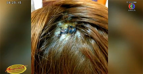 สาวเวียดนามถูกกระสุนปืนตกใส่หัว ขณะเคาท์ดาวน์ที่เซ็นทรัลเวิลด์