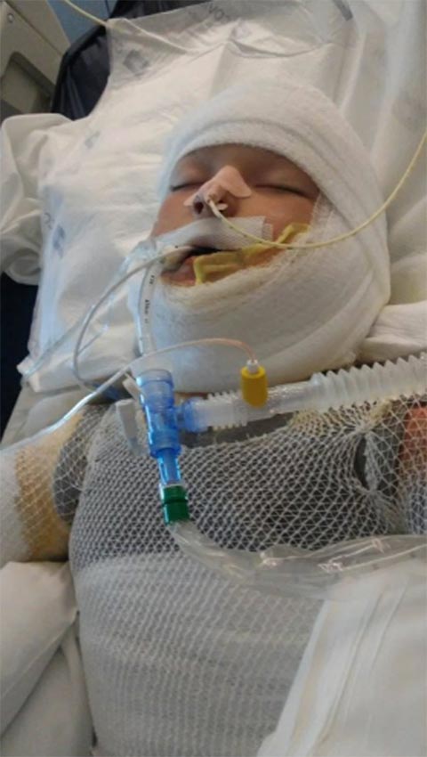 ช็อก เด็กชาย 10 ขวบถูกเพื่อนราดน้ำมัน-จุดไฟเผา ขณะเล่นด้วยกัน