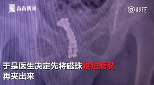 ฉี่เป็นเลือด