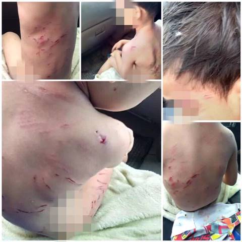 หมากัดเด็ก