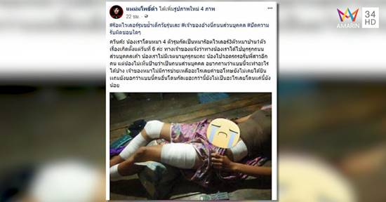 สาวเหยื่อฝูงร็อตไวเลอร์ขย้ำ