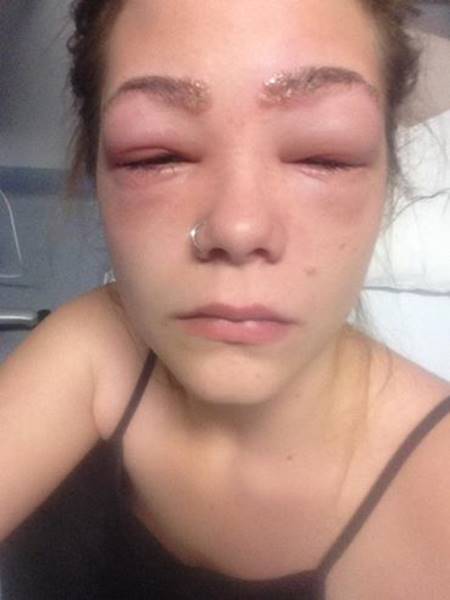 สาวสะพรึงแรง ตาหวิดบอดเพราะแพ้สารในสีย้อม หลังย้อมขนตา-ขนคิ้ว